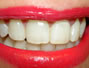 Sfaturi Dinti - Abcesul dentar